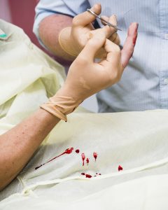 A magnet implant has been put into somebody's middle finger tip. Tehachapi, CA